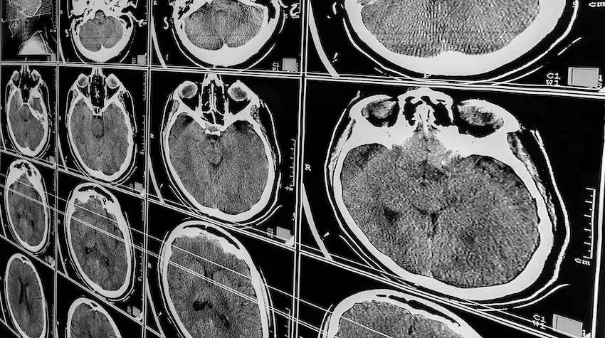 Multiple CT scan images of the human brain displaying cross-sectional views are used to diagnose traumatic brain injuries in North Carolina.