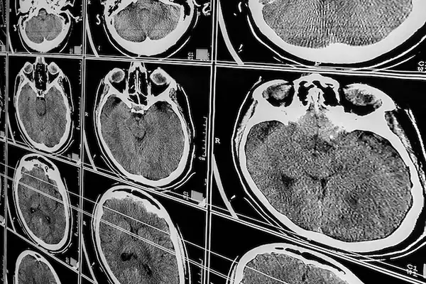 Multiple CT scan images of the human brain displaying cross-sectional views are used to diagnose traumatic brain injuries in North Carolina.